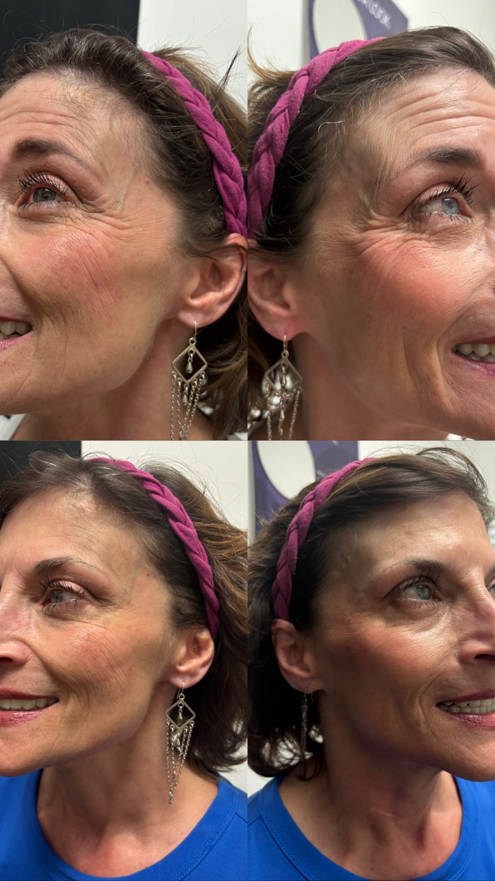 Fotos de antes y después de una paciente de Botox en Clinic 45, ambos lados del rostro en la zona de los ojos: arriba, antes del tratamiento; abajo, después