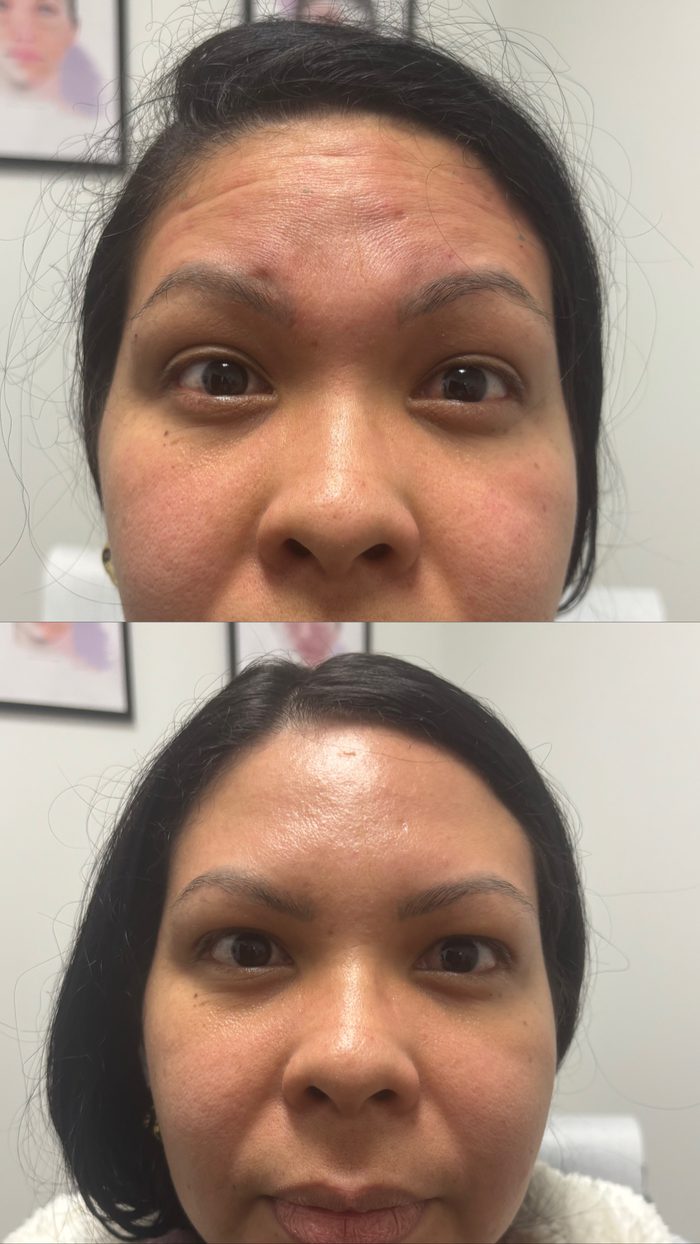 Fotos de antes y después de una paciente de Botox en Clinic 45, frente y entrecejo: arriba, antes del tratamiento; abajo, después