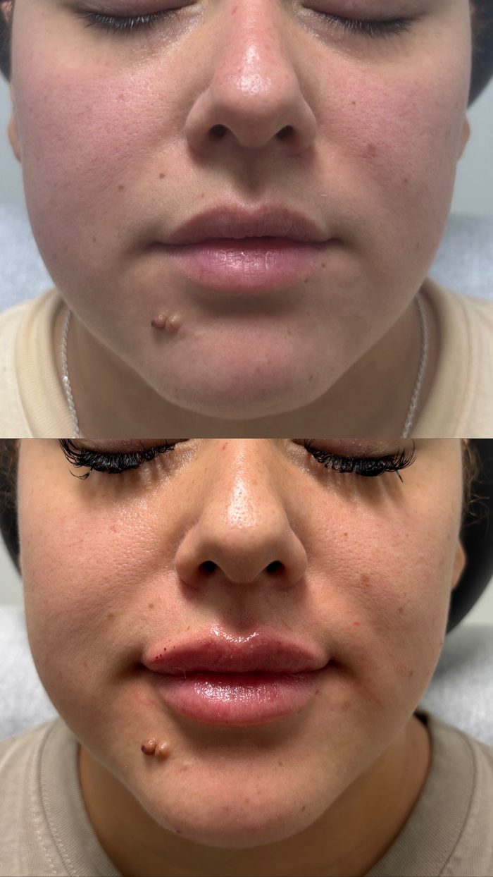 Fotos de antes y después de una paciente de relleno dérmico en Clinic 45, labios y mentón: arriba, antes del tratamiento; abajo, después