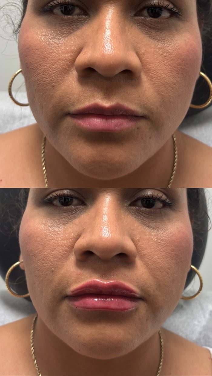 Fotos de antes y después de una paciente de relleno dérmico en Clinic 45, labios y parte baja del rostro: arriba, antes del tratamiento; abajo, después