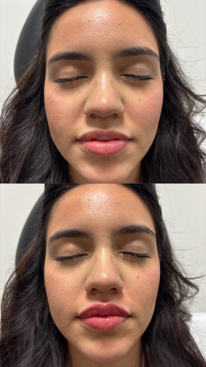 Fotos de antes y después de una paciente de relleno dérmico en Clinic 45, rostro completo de frente: arriba, antes del tratamiento; abajo, después