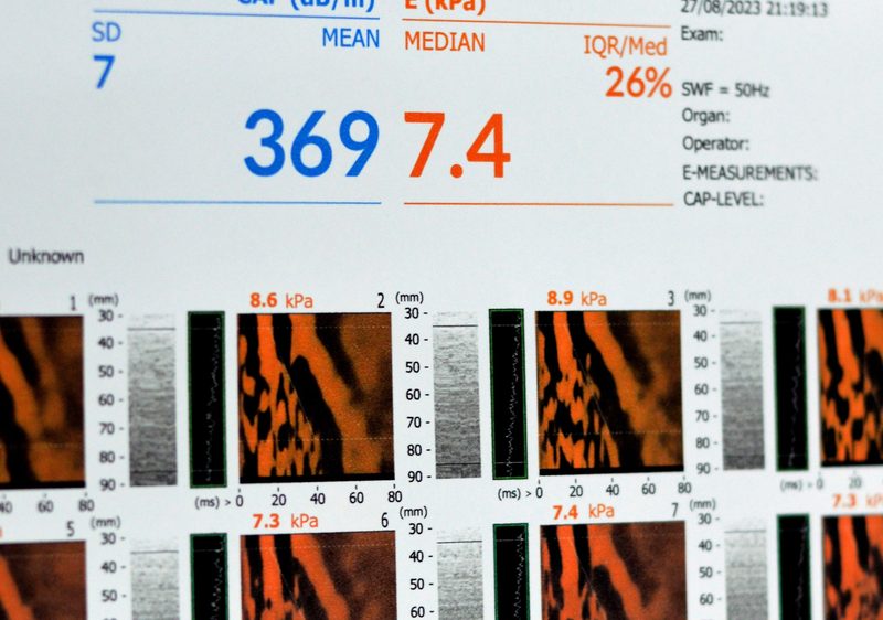 A FibroScan results report showing liver stiffness and fat measurements