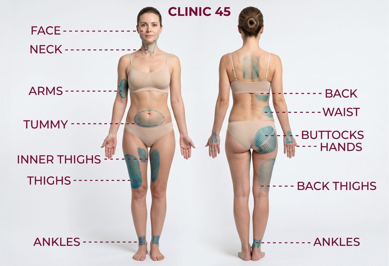 Mapa de las áreas de tratamiento para el tensado de piel en Clinic 45. Parte frontal del cuerpo: rostro, cuello, brazos, abdomen, cara interna de los muslos, muslos y tobillos. Parte posterior del cuerpo: espalda, cintura, glúteos, manos, parte posterior de los muslos y tobillos.